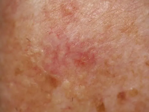 临床照片:一名 75 岁男性躯干上的基底细胞癌。两个模型均回答正确。