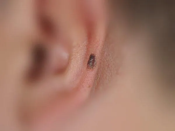 临床照片:耳部浸润性黑色素瘤,厚度小于 0.8 mm。