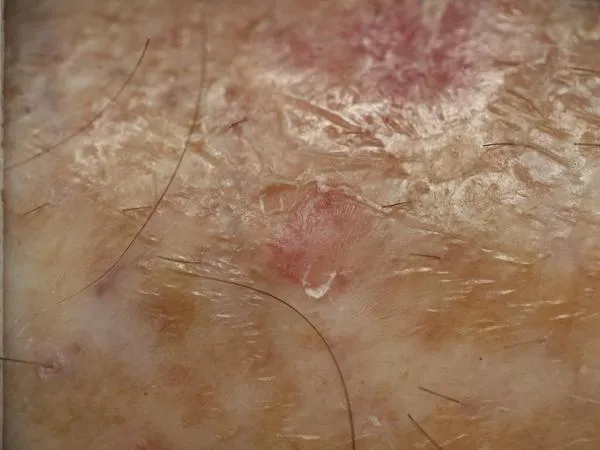 临床照片:腿部脂溢性角化病。两个模型均将其判定为日光性角化病,并认为不应让患者出院。